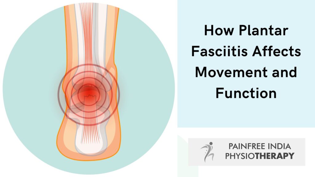 How Plantar Fasciitis Affects Movement and Function -